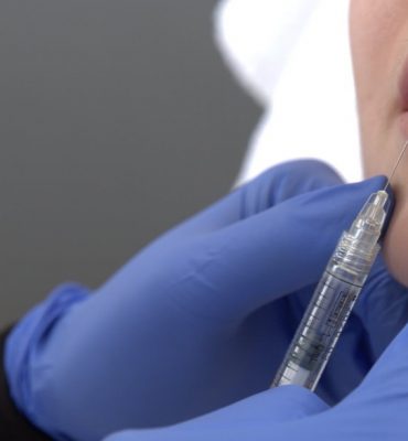 Lip augmentation with hyaluronic fillers