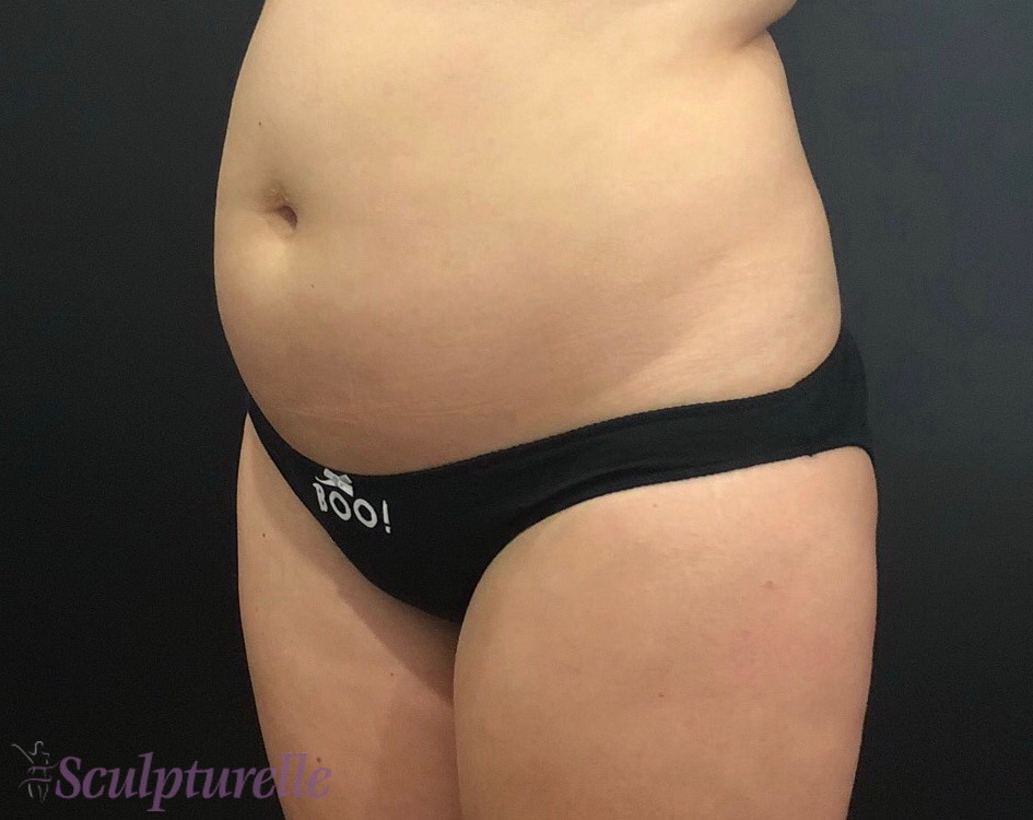 sculpturelle-body-sculpting-before-and-after-02