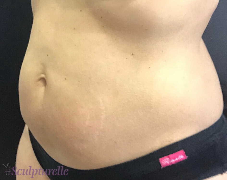 sculpturelle-body-sculpting-before-and-after-05
