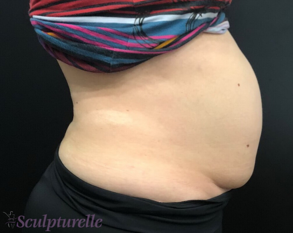 sculpturelle-body-sculpting-before-and-after-06