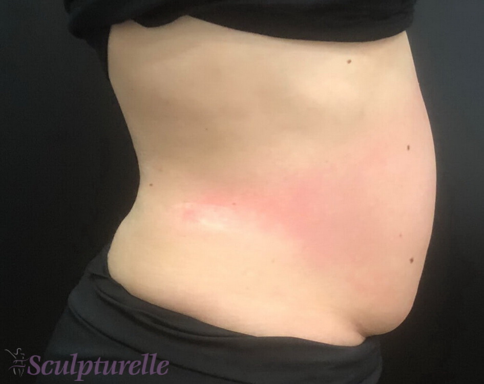 sculpturelle-body-sculpting-before-and-after-07