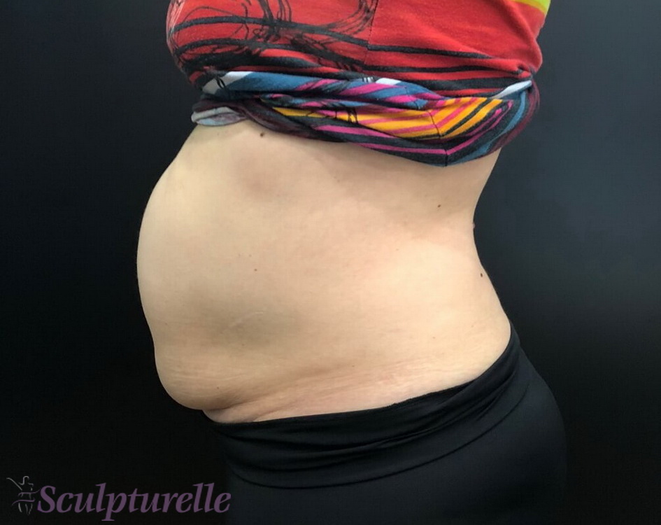 sculpturelle-body-sculpting-before-and-after-08