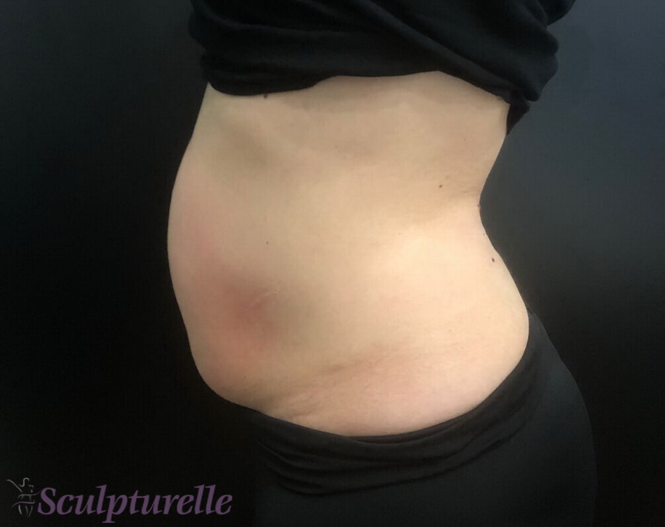 sculpturelle-body-sculpting-before-and-after-09