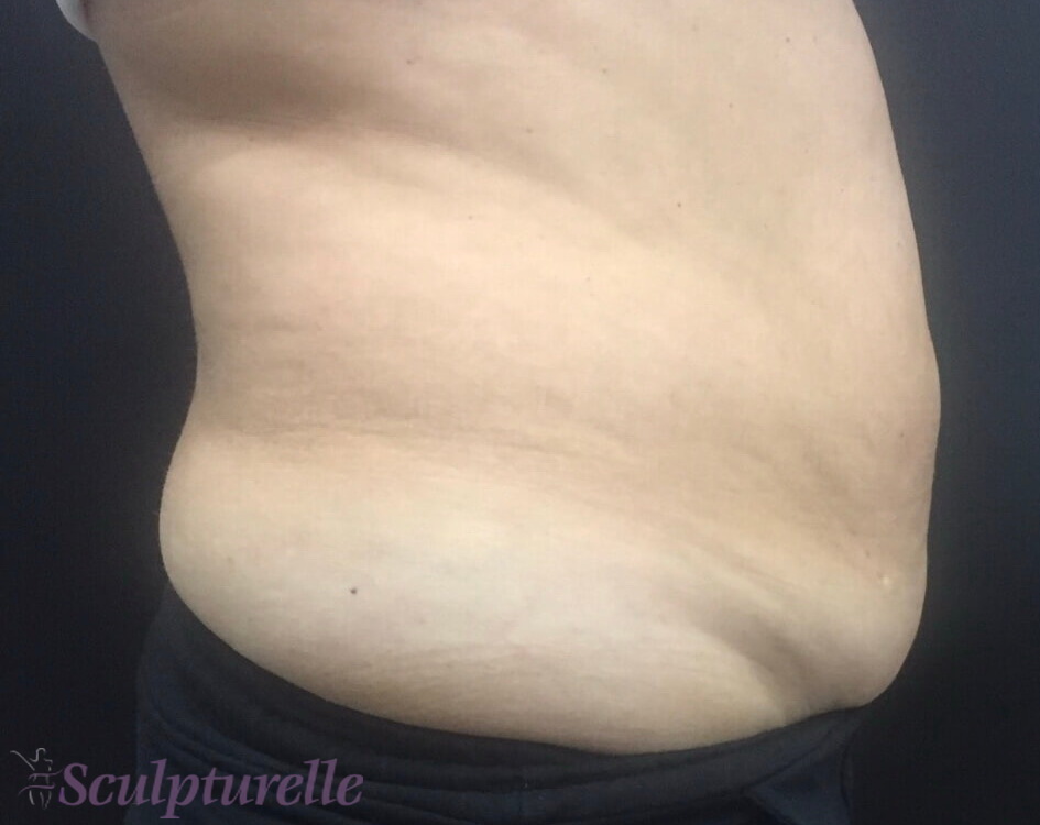 sculpturelle-body-sculpting-before-and-after-10