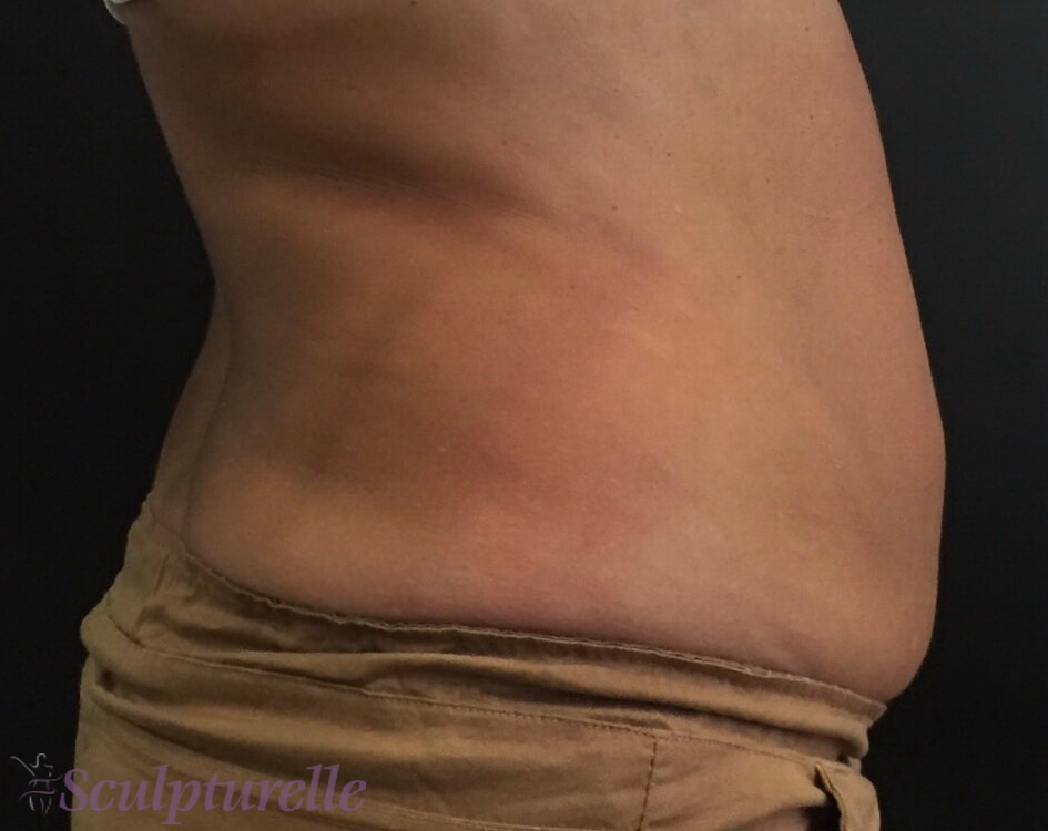 sculpturelle-body-sculpting-before-and-after-11