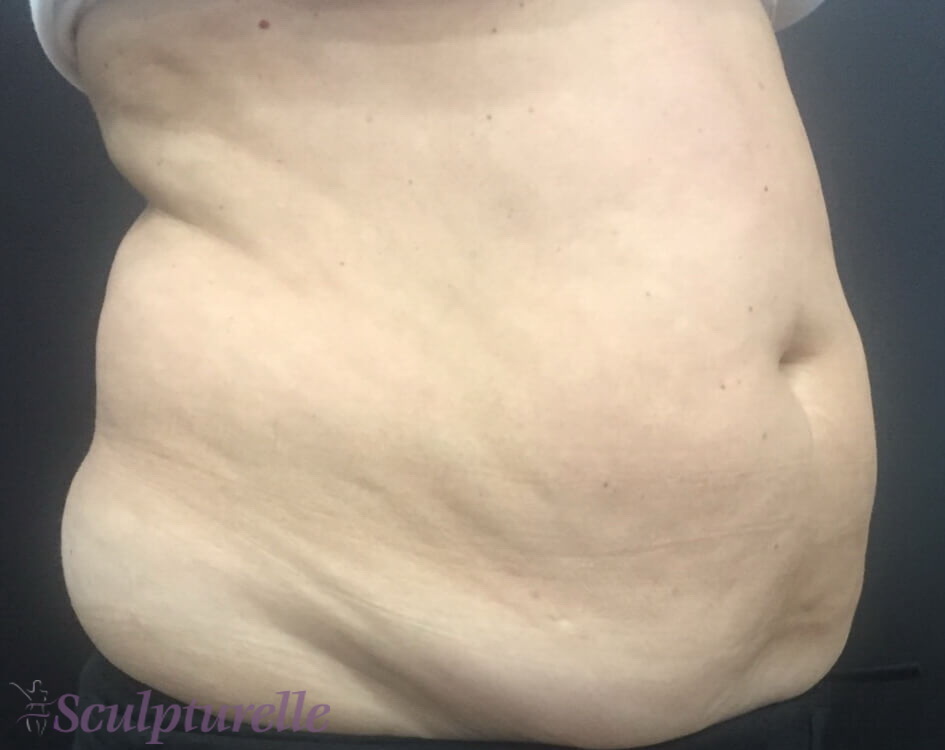 sculpturelle-body-sculpting-before-and-after-12