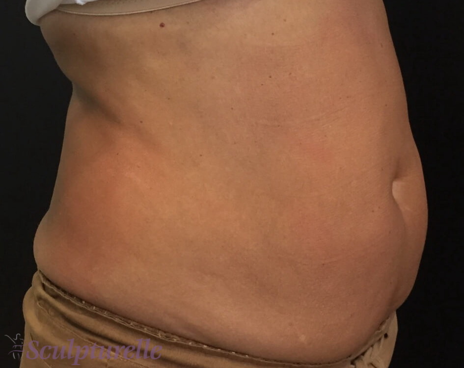 sculpturelle-body-sculpting-before-and-after-13