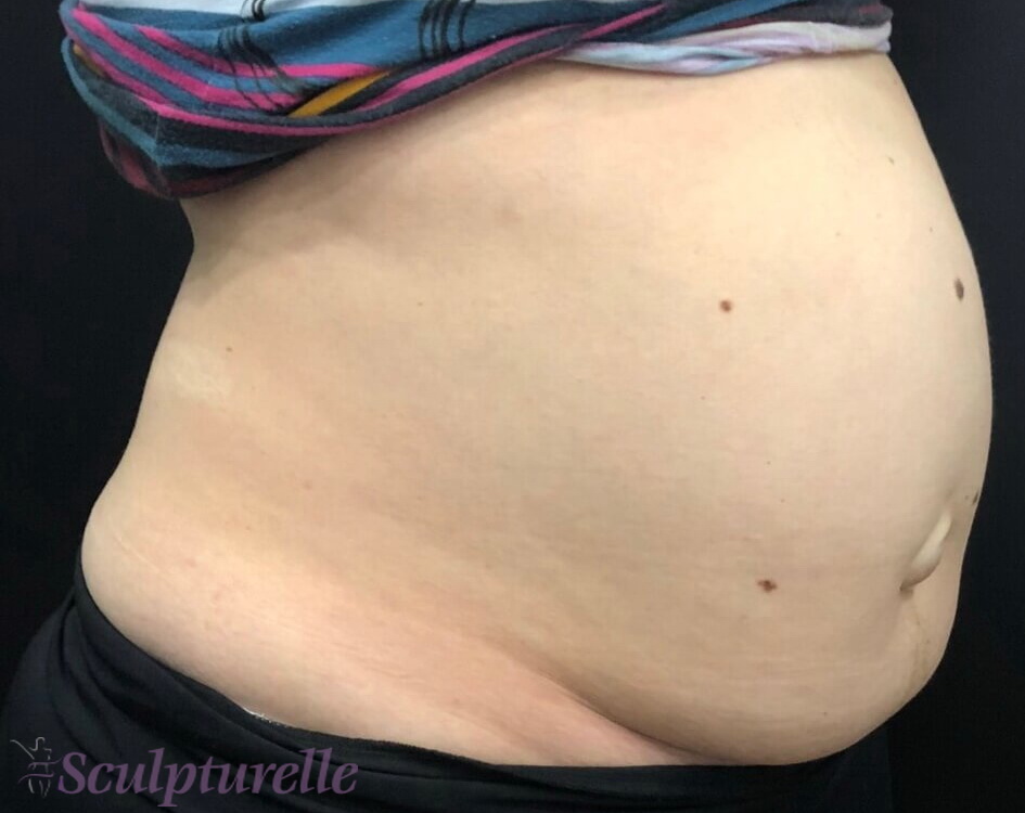 sculpturelle-body-sculpting-before-and-after-14