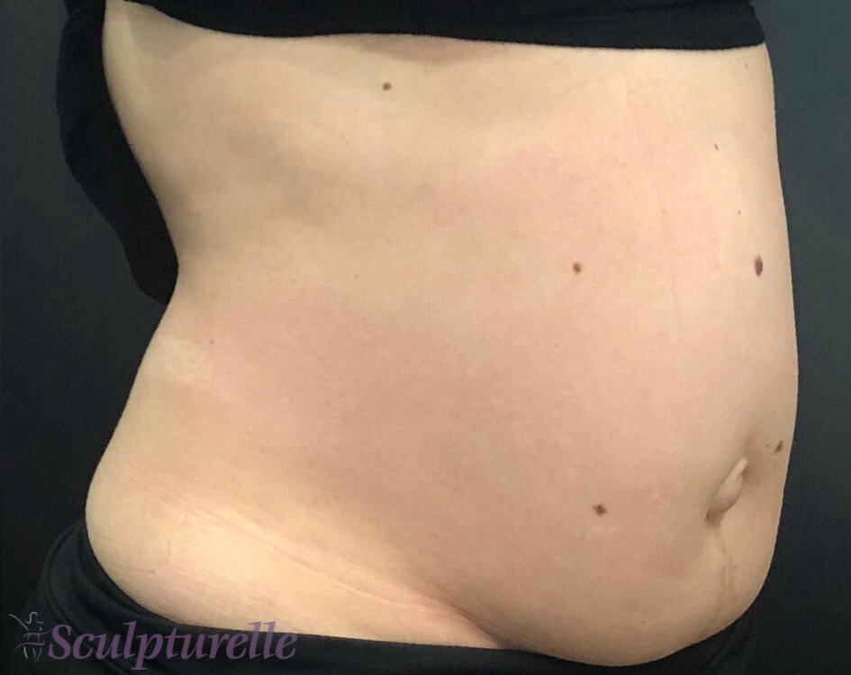 sculpturelle-body-sculpting-before-and-after-15