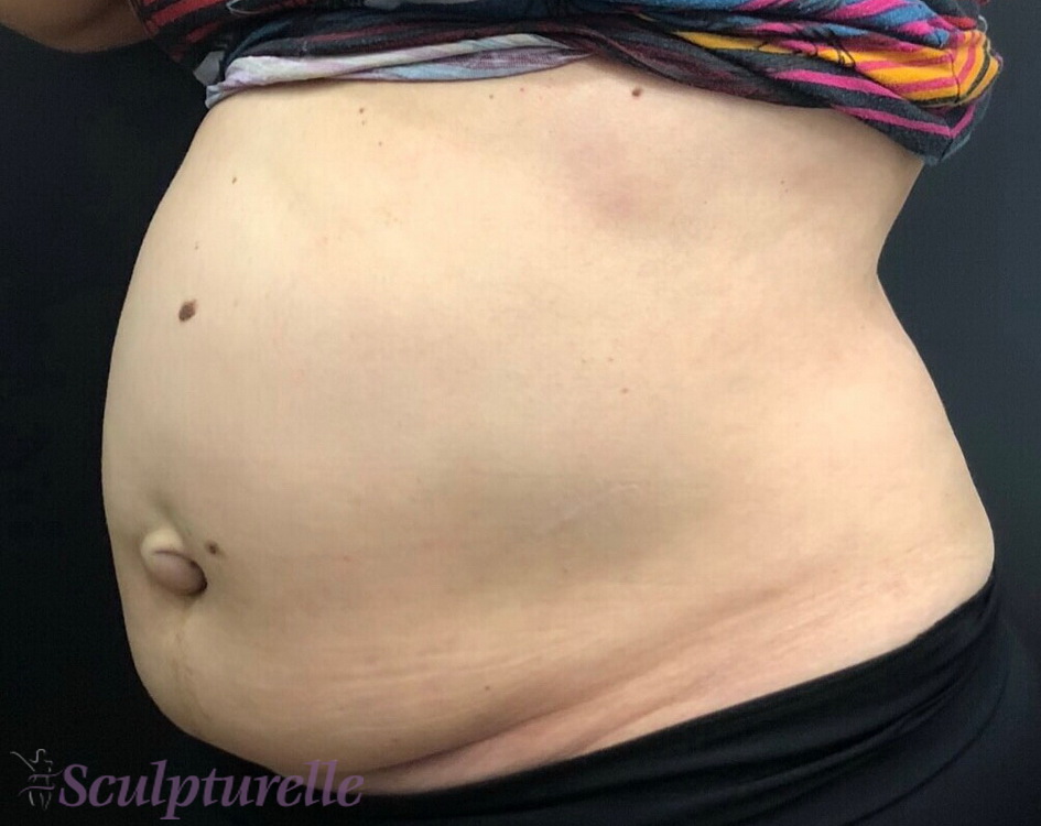 sculpturelle-body-sculpting-before-and-after-16