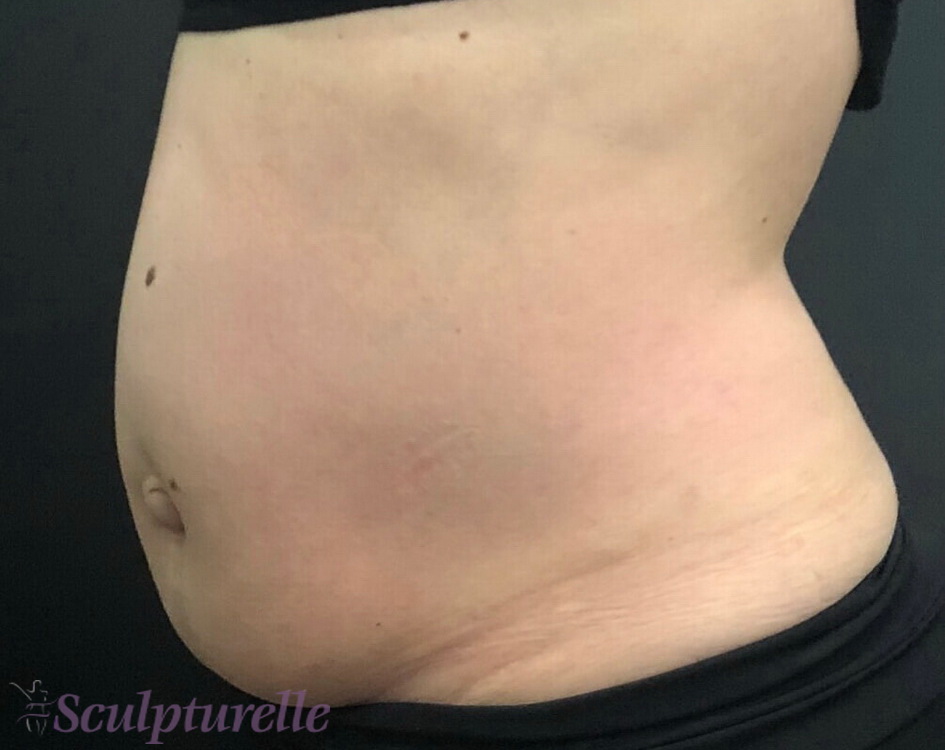 sculpturelle-body-sculpting-before-and-after-17