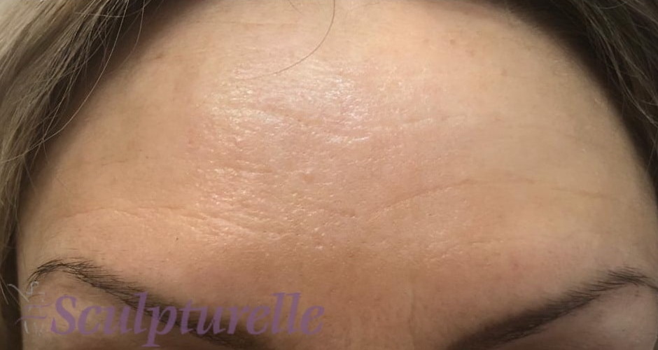 sculpturelle-wrinkle-correction-before-and-after-01