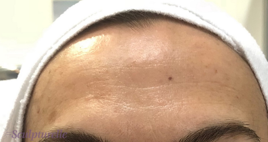 sculpturelle-wrinkle-correction-before-and-after-02