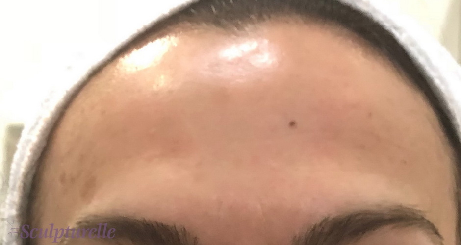 sculpturelle-wrinkle-correction-before-and-after-03