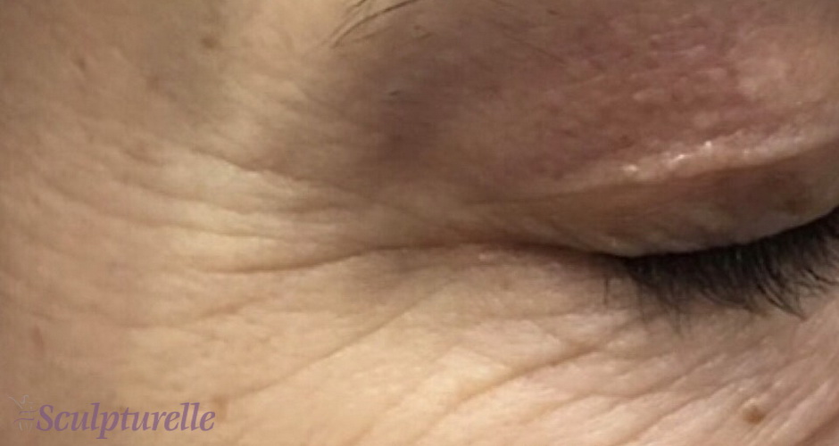 sculpturelle-wrinkle-correction-before-and-after-04