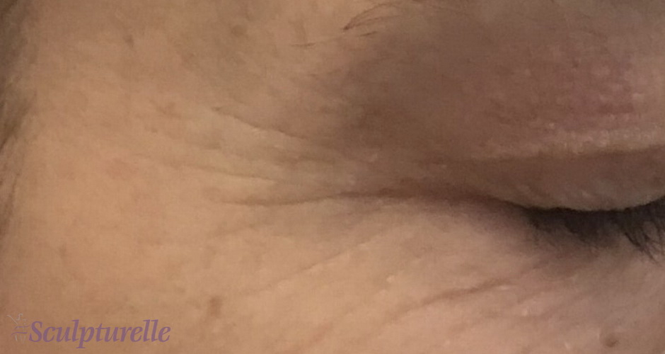 sculpturelle-wrinkle-correction-before-and-after-05