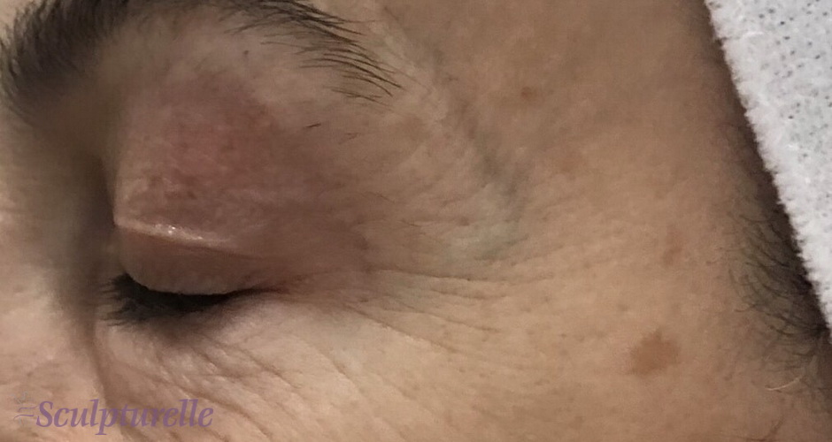 sculpturelle-wrinkle-correction-before-and-after-06