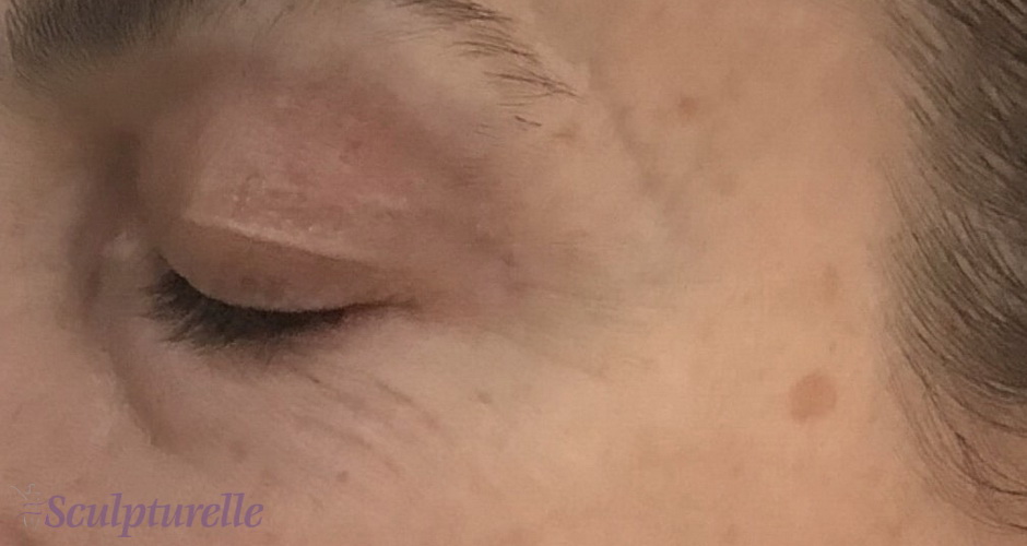 sculpturelle-wrinkle-correction-before-and-after-07