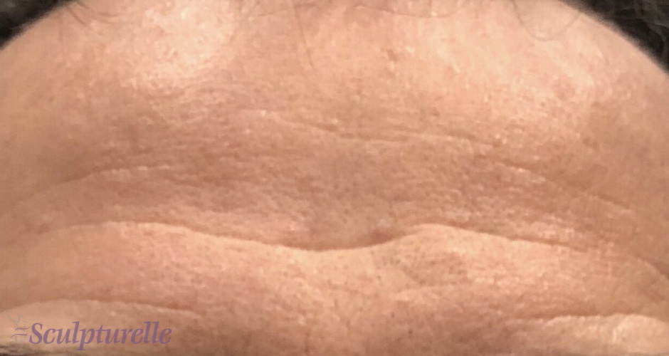 sculpturelle-wrinkle-correction-before-and-after-08