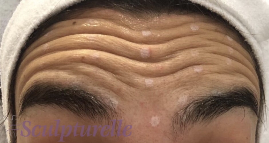 sculpturelle-wrinkle-correction-before-and-after-10