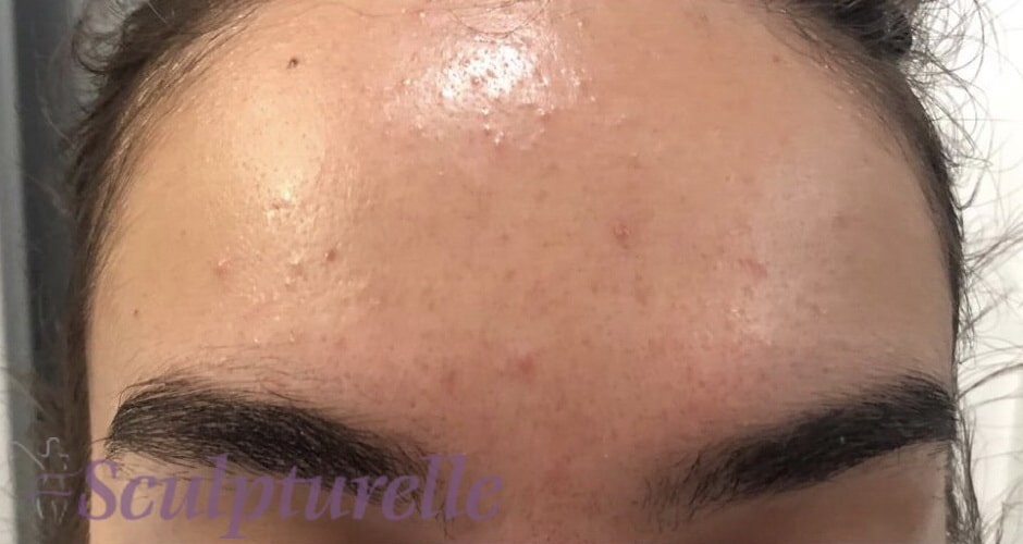 sculpturelle-wrinkle-correction-before-and-after-11