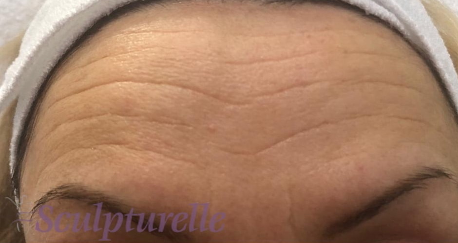 sculpturelle-wrinkle-correction-before-and-after